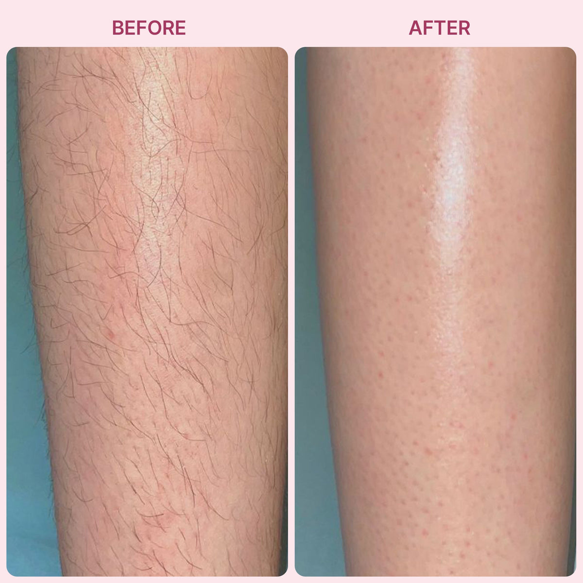 Painless Hair Remover