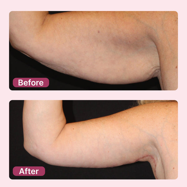 Anti-Cellulite Ultrasonic Body Sculptor – Tone, Firm & Target Fat at Home
